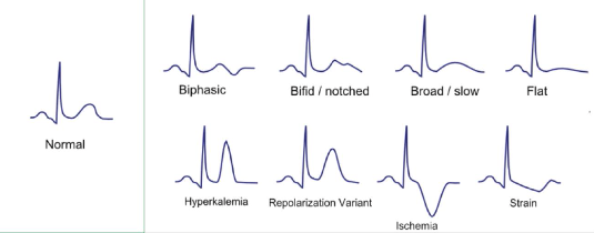 ECG classification